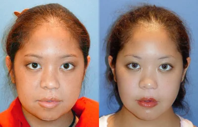 Cleft Lip Reconstruction