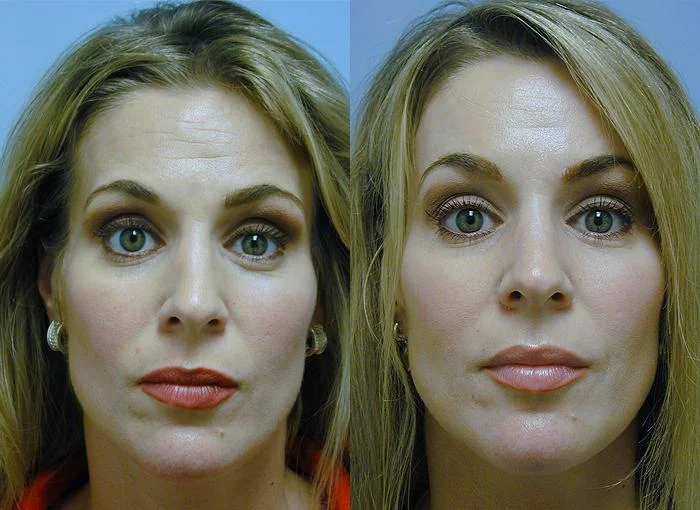 Forehead & Eyebrow Elevation