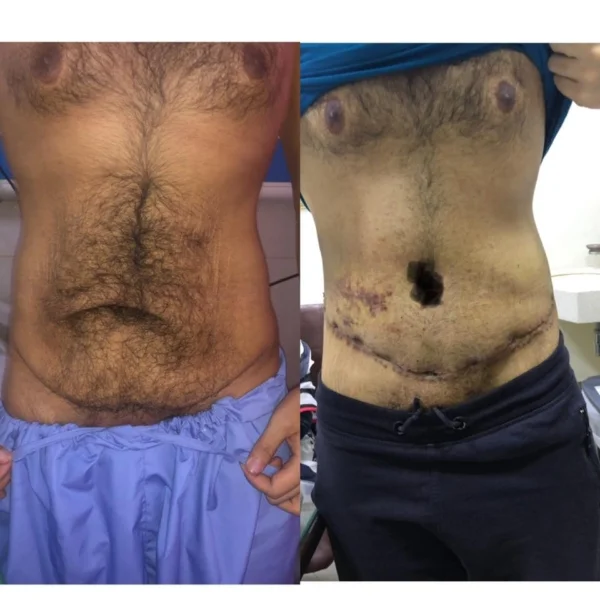 Body Contouring: Tummy Tuck & Liposuction