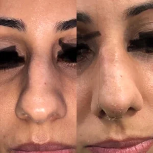 Rhinoplasty (Nose Job Surgery)